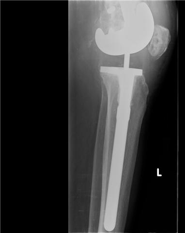 Case 1 Periprosthetic Fracture Dr Girish Dewnany