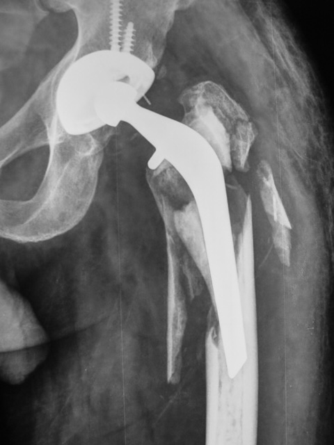 Case Periprosthetic Fracture Total Hip Replacement Dr Girish