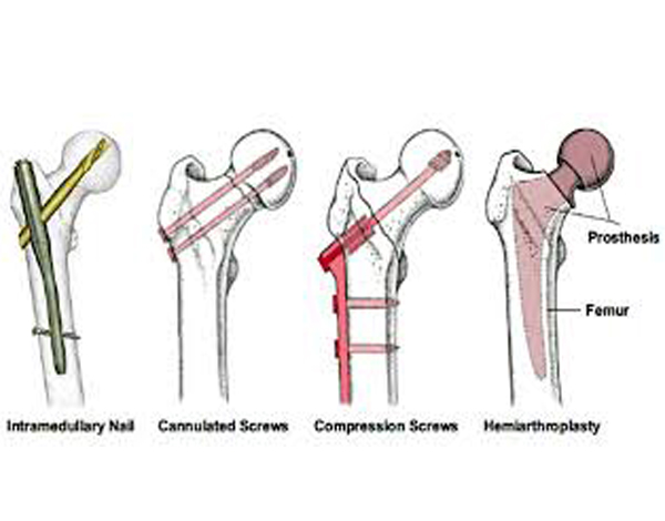 Hip Fractures Dr Girish Dewnany