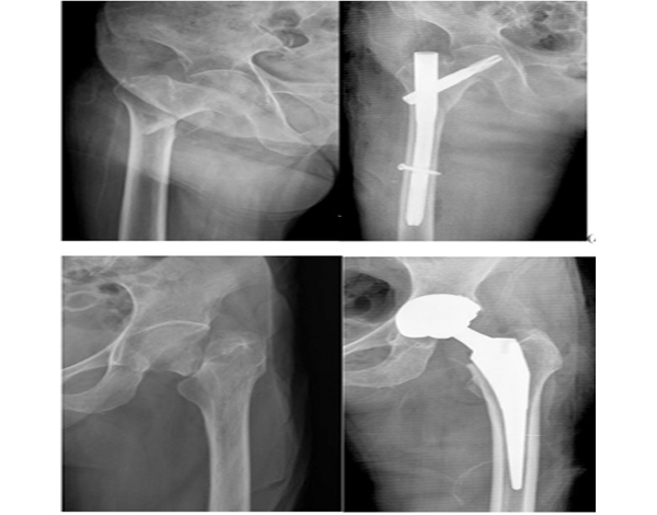 Hip Fractures – Dr. Girish Dewnany