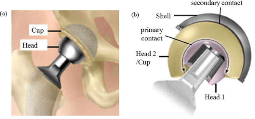 Types Of Hip Replacement Dr Girish Dewnany