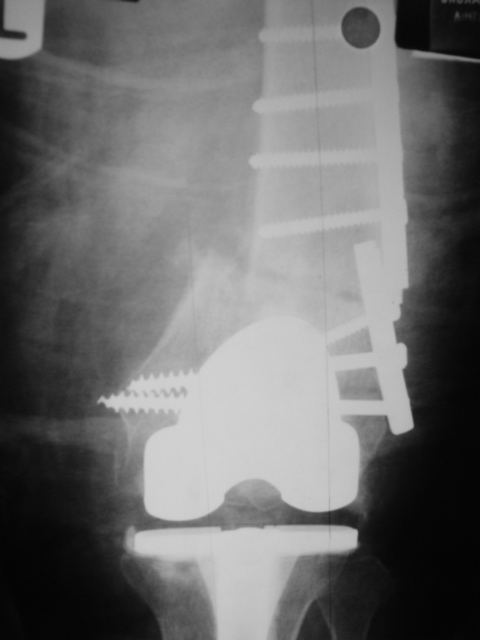 Case Periprosthetic Fracture Dr Girish Dewnany