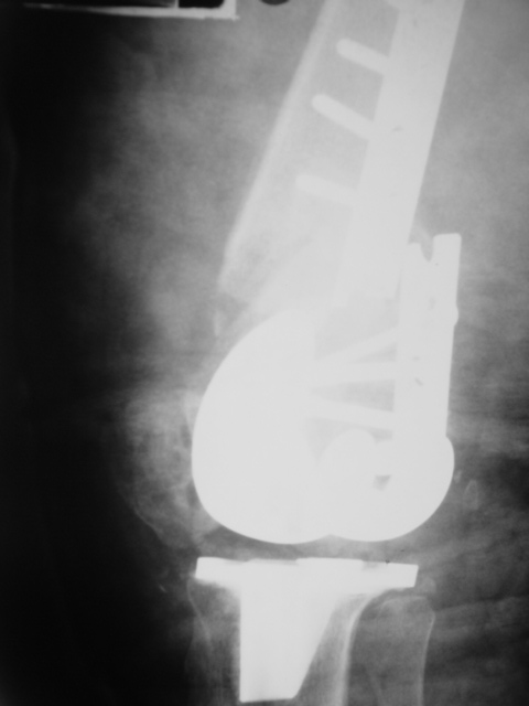 Case Periprosthetic Fracture Dr Girish Dewnany